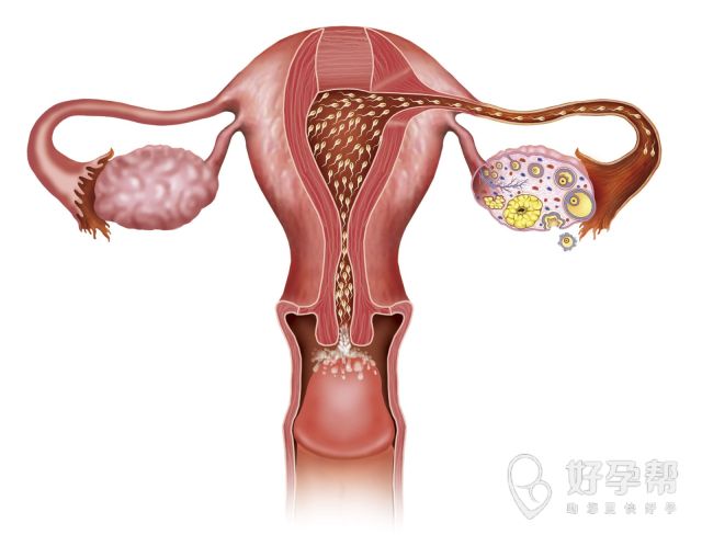 多囊卵巢能调理好吗?多囊卵巢如何调理?