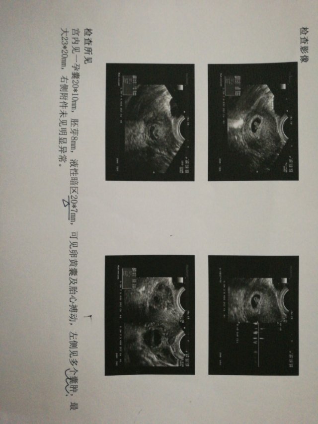 天津中医药大学第一附属医院彩超看有胎心胎芽,有液性暗区是有先兆