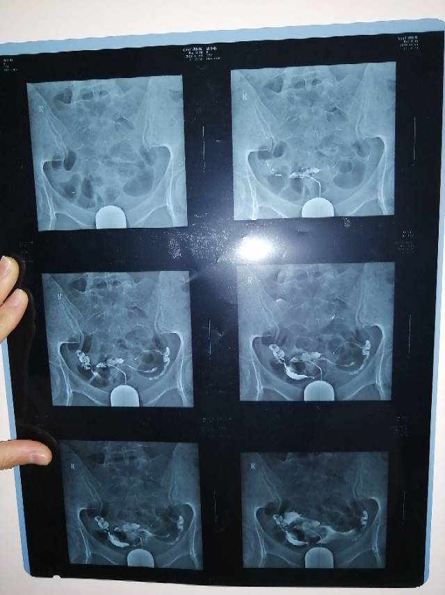 這是我做的輸卵管造影檢查我想問一下我的輸卵管