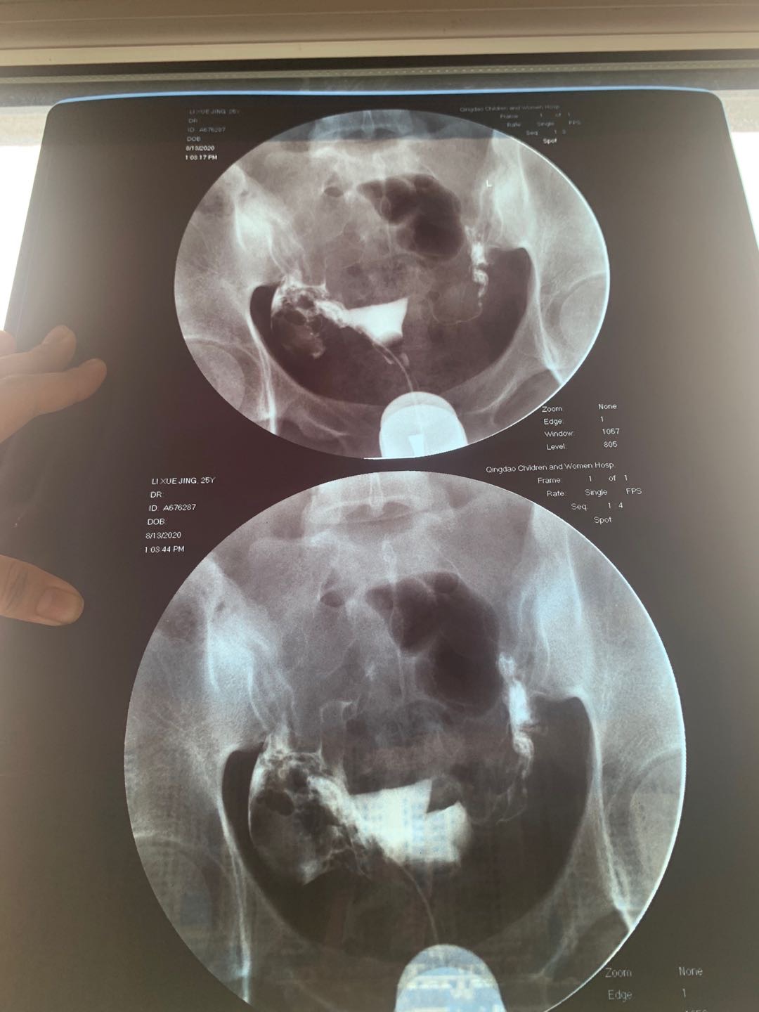 做了输卵管造影显示双侧通而不畅左侧医生看了片