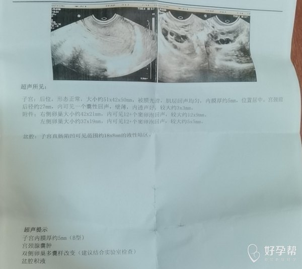 什么叫做多囊卵泡 gw-topic