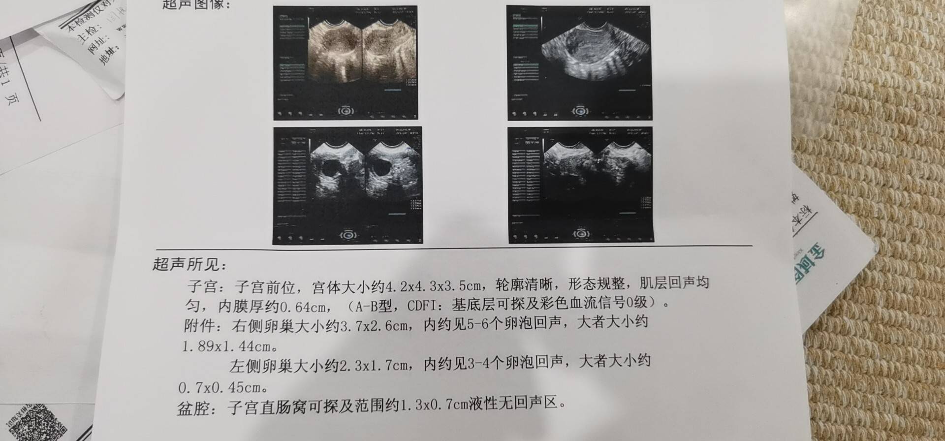 四維彩超檢查子宮內膜血流信號0級處於即將排卵