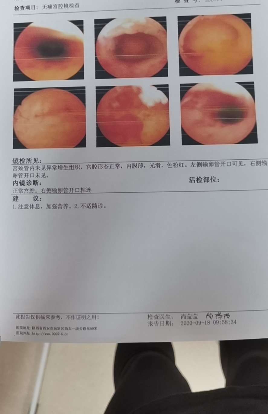 去年做宫腔镜检查结果是输卵管一侧开口粘连连续