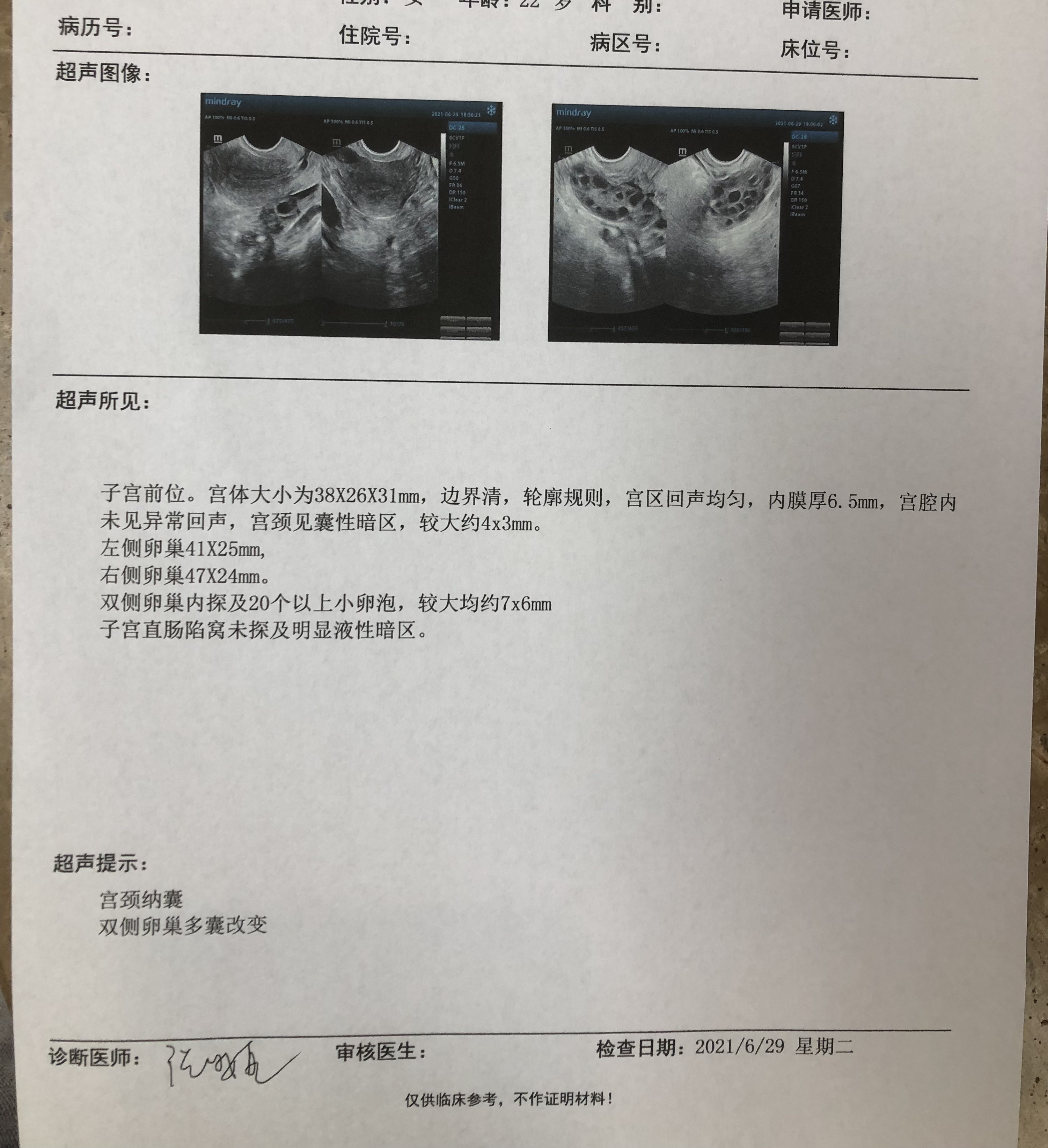 山东省临沭县妇幼保健院宫颈纳囊就是宫颈囊肿,慢性宫颈炎的一种