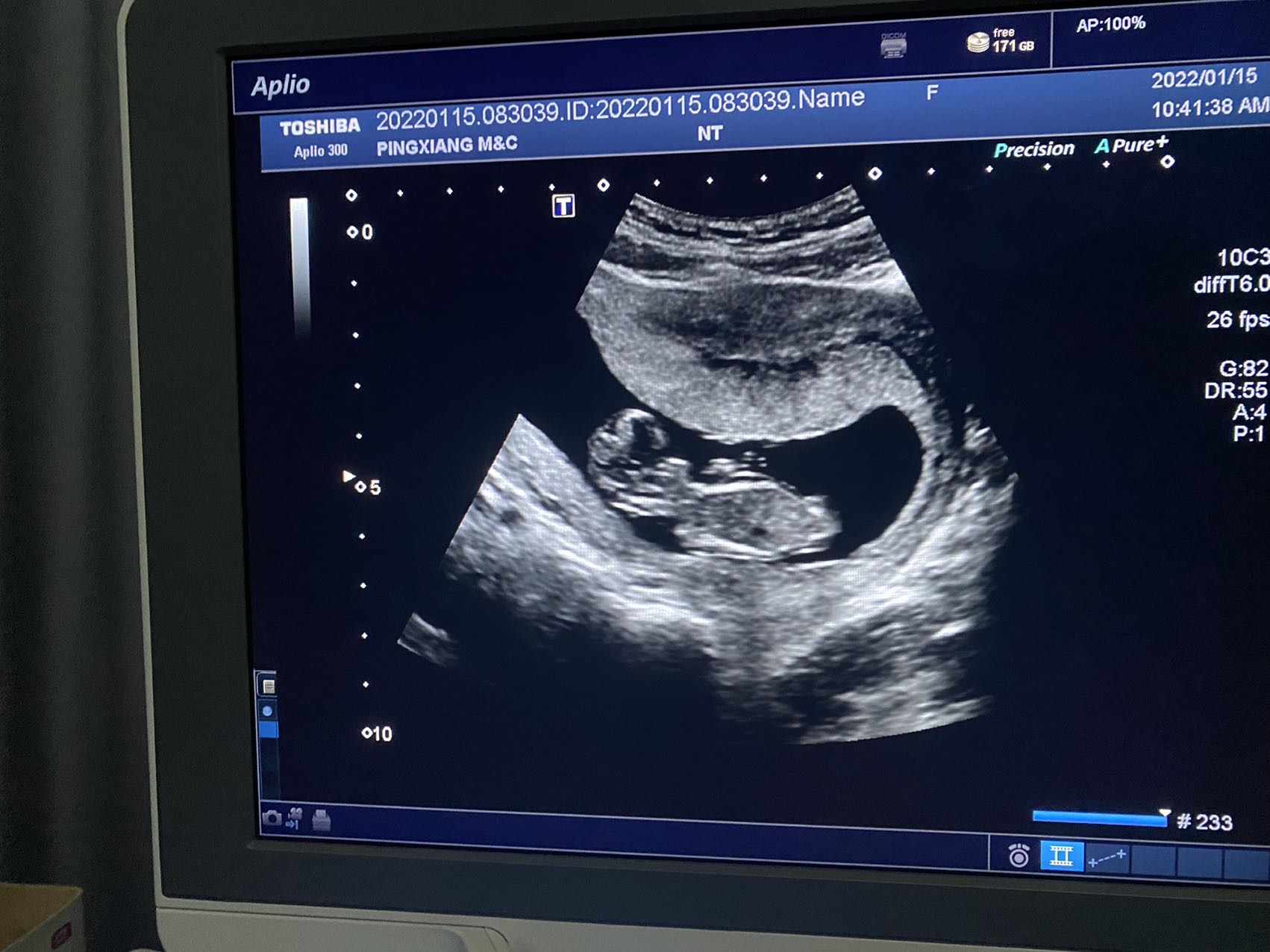 怀孕十一周胎儿高清图图片
