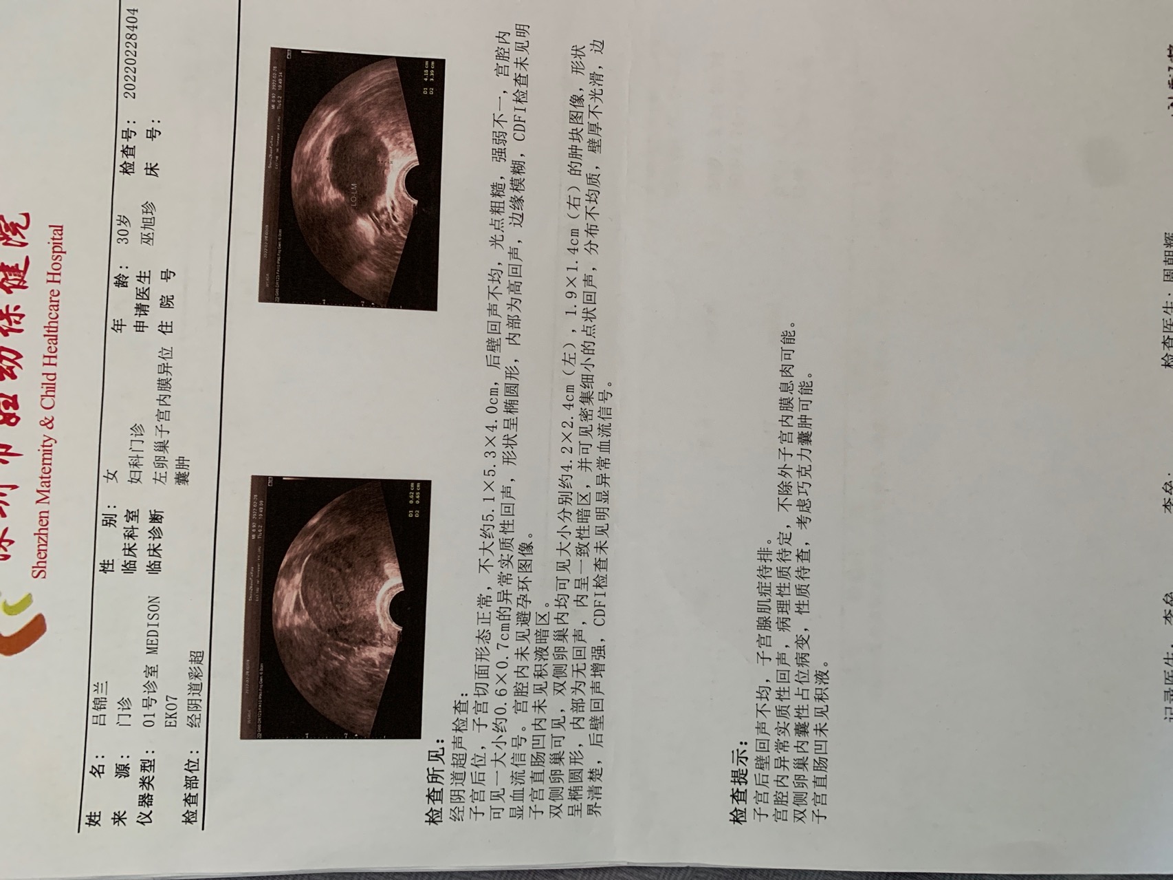 子宫腺肌症超声报告图片