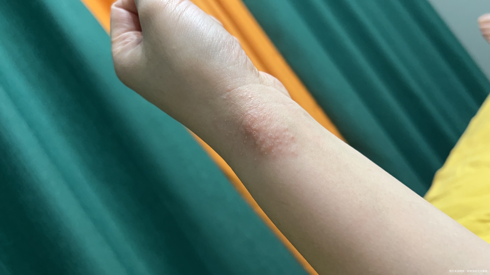 湿疹土方_湿疹最怕一个克星土方_湿疹有土方子治吗